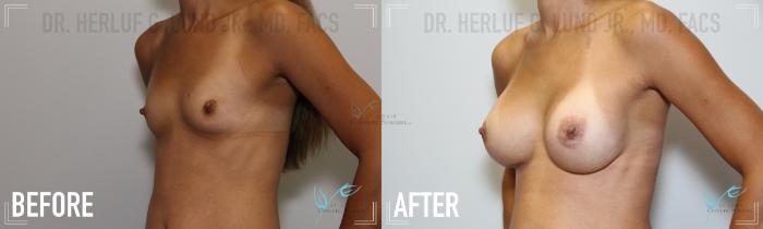 Before & After Breast Augmentation Case 165 Left Oblique View in St. Louis, MO