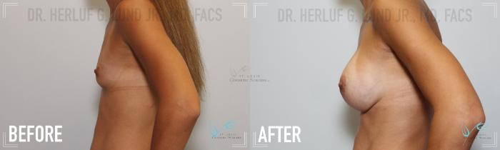 Before & After Breast Augmentation Case 165 Left Side View in St. Louis, MO