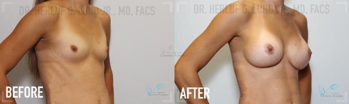 Before & After Breast Augmentation Case 165 Right Oblique View in St. Louis, MO