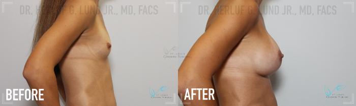 Before & After Breast Augmentation Case 165 Right Side View in St. Louis, MO
