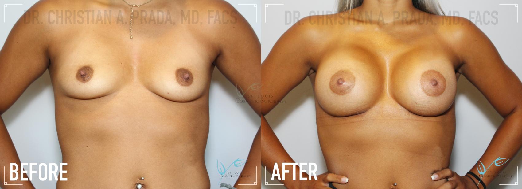 Breast Augmentation Before & After Photo | St. Louis, MO | St. Louis Cosmetic Surgery