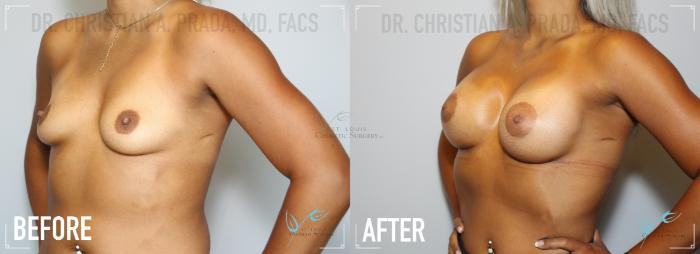 Before & After Breast Augmentation Case 166 Left Oblique View in St. Louis, MO