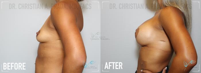 Before & After Breast Augmentation Case 166 Left Side View in St. Louis, MO