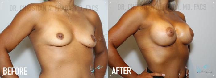 Before & After Breast Augmentation Case 166 Right Oblique View in St. Louis, MO