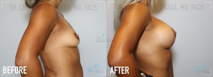 Before & After Breast Augmentation Case 166 Right Side View in St. Louis, MO