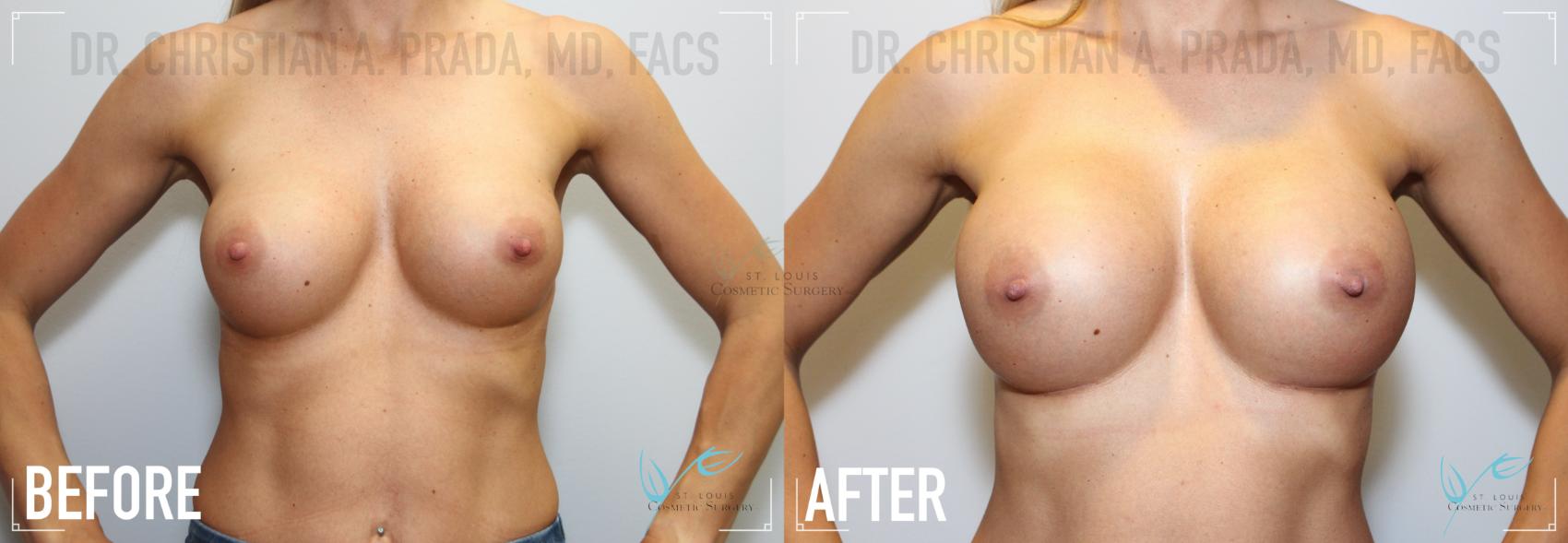 Before & After Breast Augmentation Case 167 Front View in St. Louis, MO