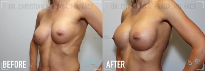 Before & After Breast Augmentation Case 167 Right Oblique View in St. Louis, MO
