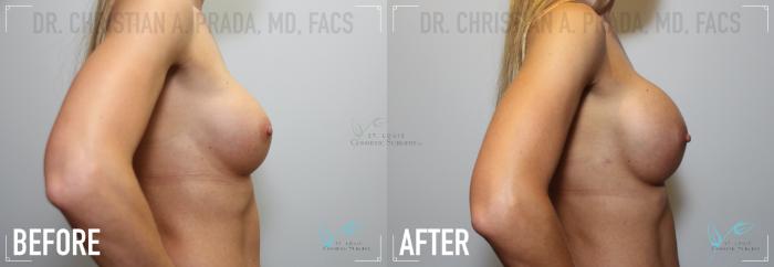 Before & After Breast Augmentation Case 167 Right Side View in St. Louis, MO