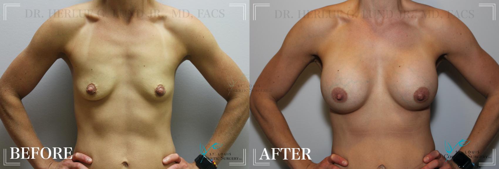 Before & After Breast Augmentation Case 172 Front View in St. Louis, MO