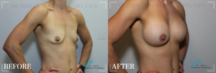 Before & After Breast Augmentation Case 172 Right Oblique View in St. Louis, MO