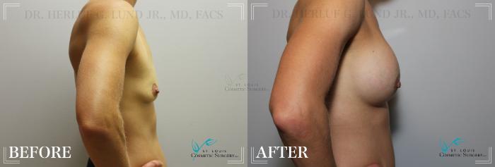 Before & After Breast Augmentation Case 172 Right Side View in St. Louis, MO