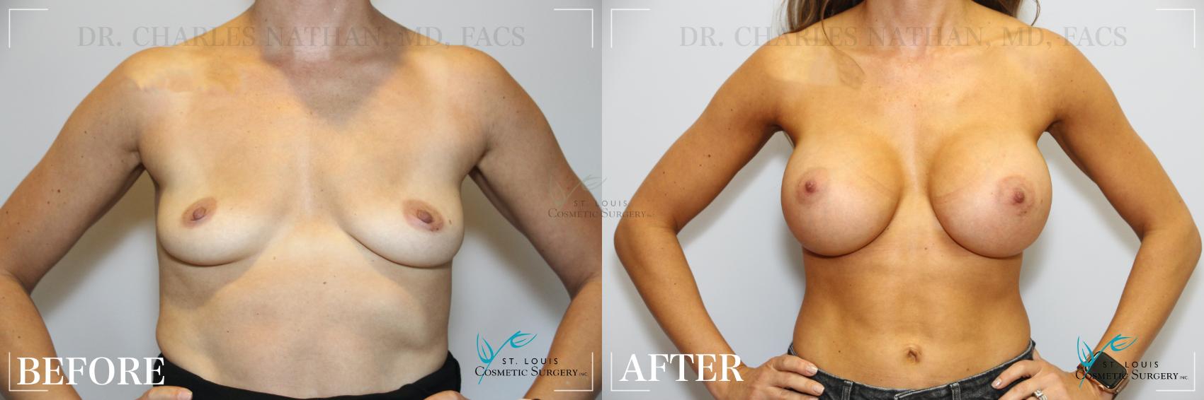 Before & After Breast Augmentation Case 176 Front View in St. Louis, MO
