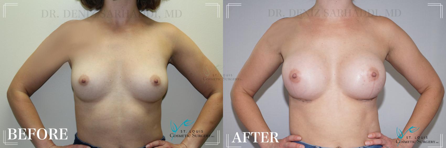 Before & After Breast Augmentation Case 177 Front View in St. Louis, MO