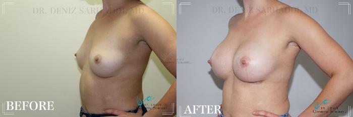 Before & After Breast Augmentation Case 177 Right Oblique View in St. Louis, MO