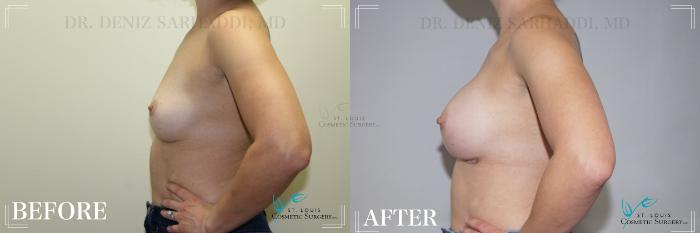 Before & After Breast Augmentation Case 177 Right Side View in St. Louis, MO