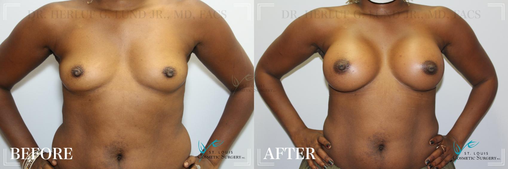Before & After Breast Augmentation Case 178 Front View in St. Louis, MO
