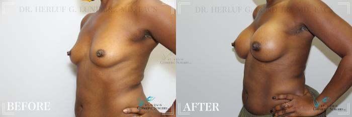Before & After Breast Augmentation Case 178 Left Oblique View in St. Louis, MO