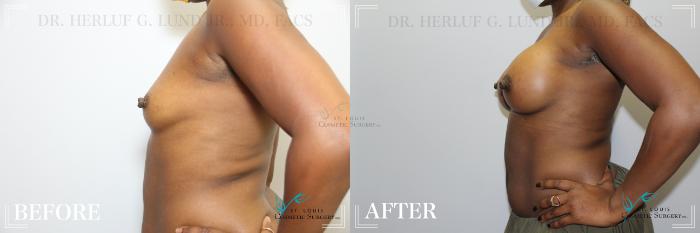 Before & After Breast Augmentation Case 178 Left Side View in St. Louis, MO
