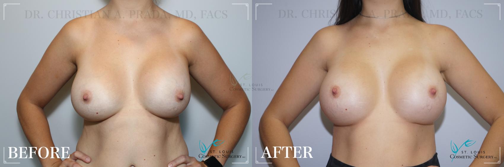 Before & After Breast Augmentation Case 183 Front View in St. Louis, MO