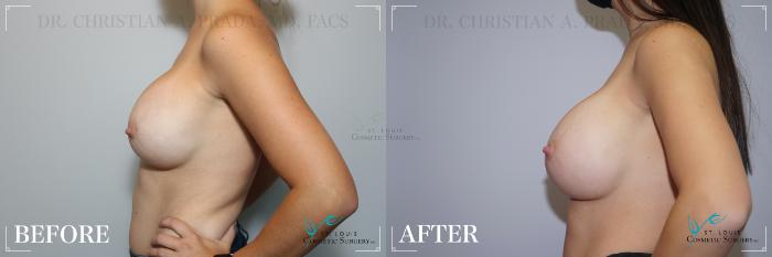 Before & After Breast Augmentation Case 183 Left Side View in St. Louis, MO