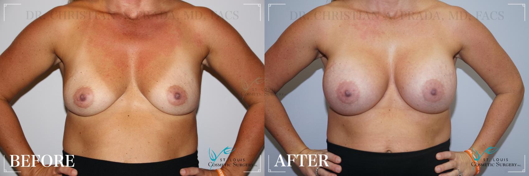 Before & After Breast Augmentation Case 201 Front View in St. Louis, MO