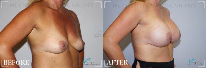 Before & After Breast Augmentation Case 201 Right Oblique View in St. Louis, MO