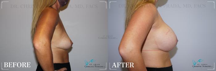 Before & After Breast Augmentation Case 201 Right Side View in St. Louis, MO
