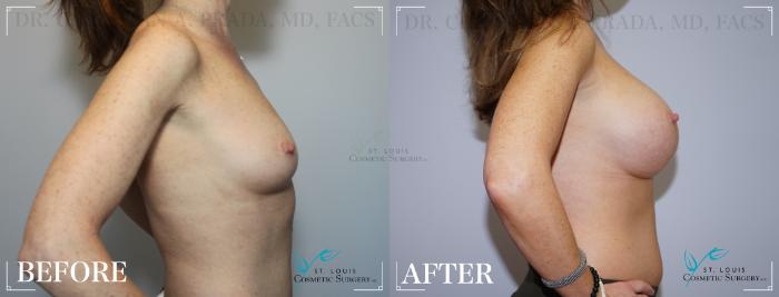 Before & After Breast Augmentation Case 202 Right Side View in St. Louis, MO