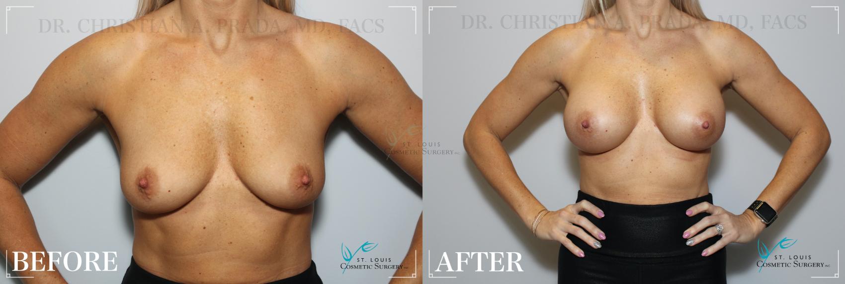 Before & After Breast Augmentation Case 205 Front View in St. Louis, MO