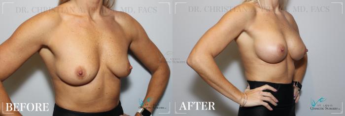 Before & After Breast Augmentation Case 205 Right Oblique View in St. Louis, MO