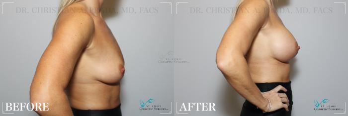 Before & After Breast Augmentation Case 205 Right Side View in St. Louis, MO