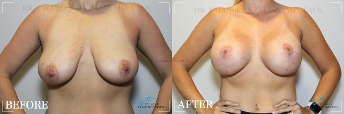 Before & After Breast Augmentation Case 206 Front View in St. Louis, MO