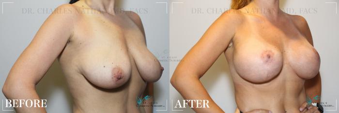 Before & After Breast Augmentation Case 206 Right Oblique View in St. Louis, MO