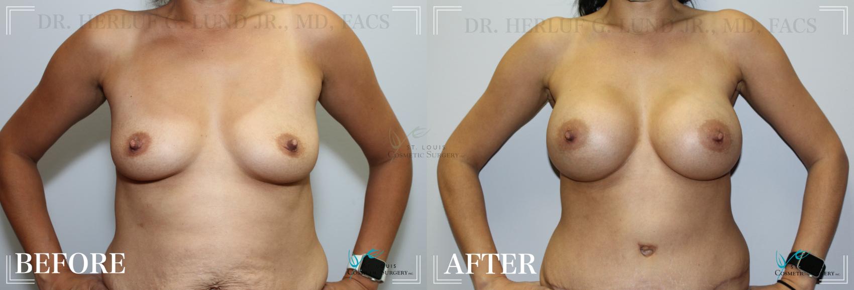 Before & After Breast Augmentation Case 208 Front View in St. Louis, MO