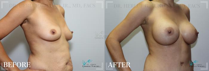 Before & After Breast Augmentation Case 208 Right Oblique View in St. Louis, MO