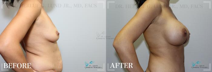 Before & After Breast Augmentation Case 208 Right Side View in St. Louis, MO