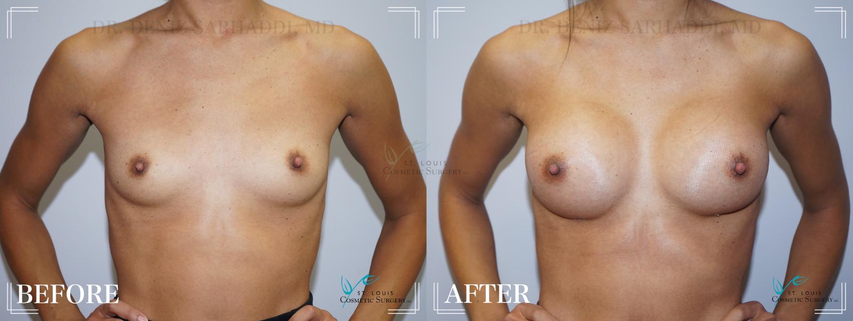 Before & After Breast Augmentation Case 209 Front View in St. Louis, MO