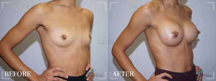 Before & After Breast Augmentation Case 209 Right Oblique View in St. Louis, MO