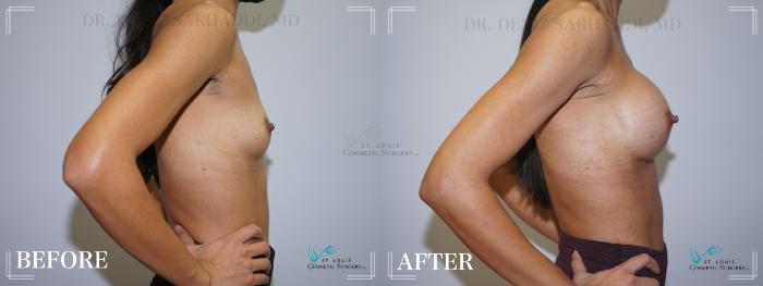 Before & After Breast Augmentation Case 209 Right Side View in St. Louis, MO