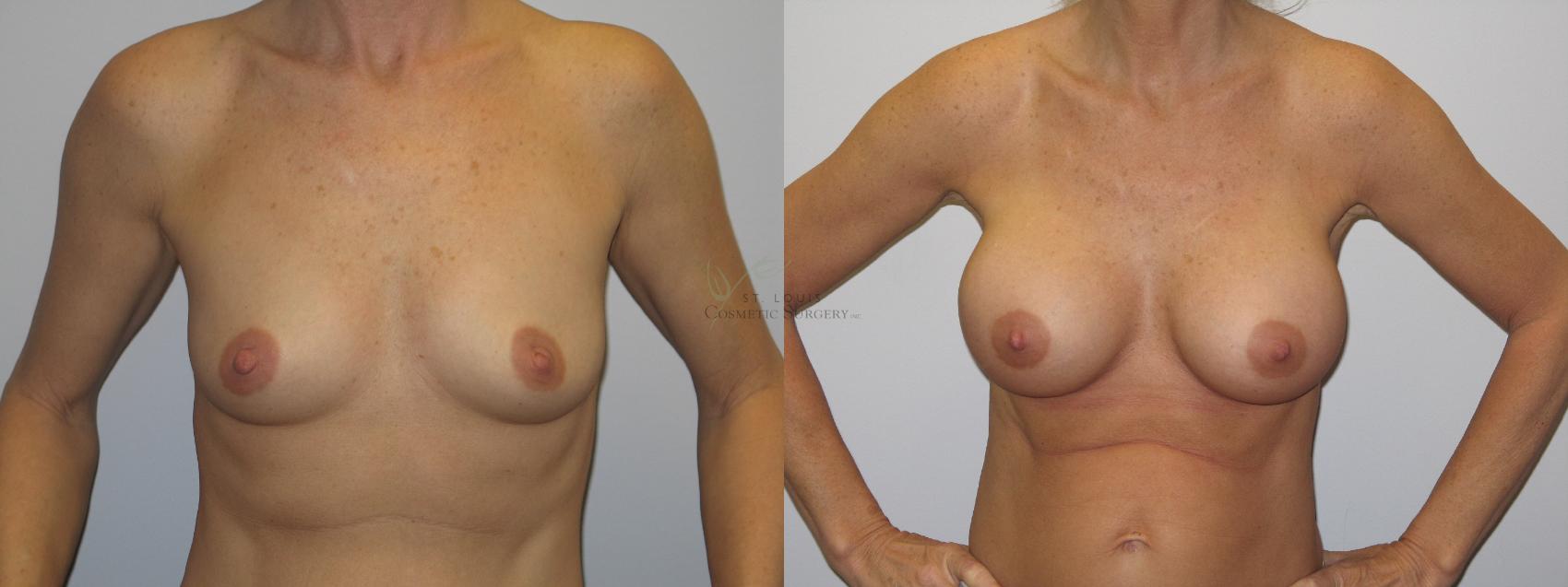 Before & After Breast Augmentation Case 21 View #1 View in St. Louis, MO