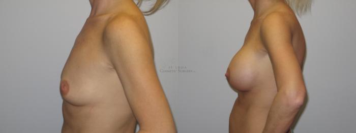 Before & After Breast Augmentation Case 21 View #2 View in St. Louis, MO