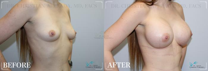 Before & After Breast Augmentation Case 214 Right Oblique View in St. Louis, MO