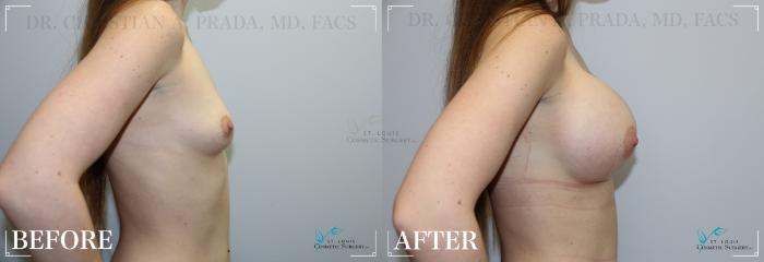 Before & After Breast Augmentation Case 214 Right Side View in St. Louis, MO