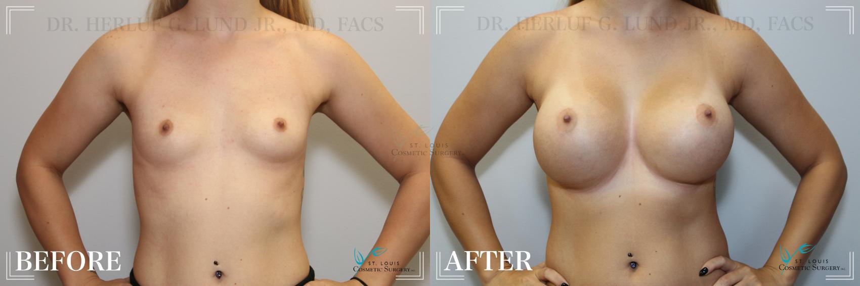 Before & After Breast Augmentation Case 224 Front View in St. Louis, MO