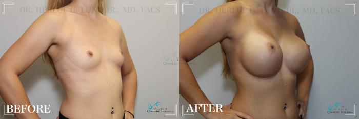Before & After Breast Augmentation Case 224 Right Oblique View in St. Louis, MO