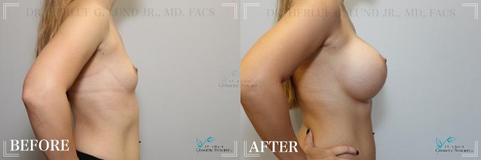 Before & After Breast Augmentation Case 224 Right Side View in St. Louis, MO