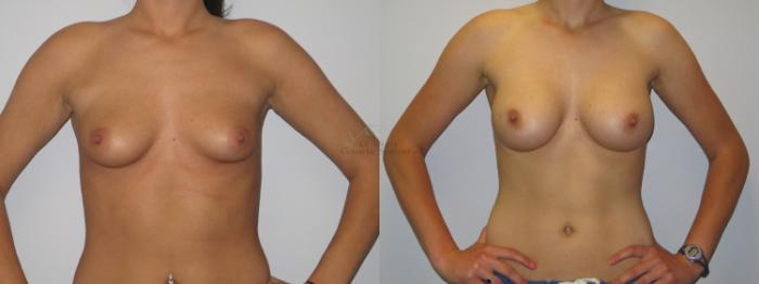 Before & After Breast Augmentation Case 23 View #1 View in St. Louis, MO