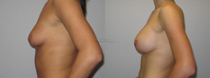 Before & After Breast Augmentation Case 23 View #2 View in St. Louis, MO
