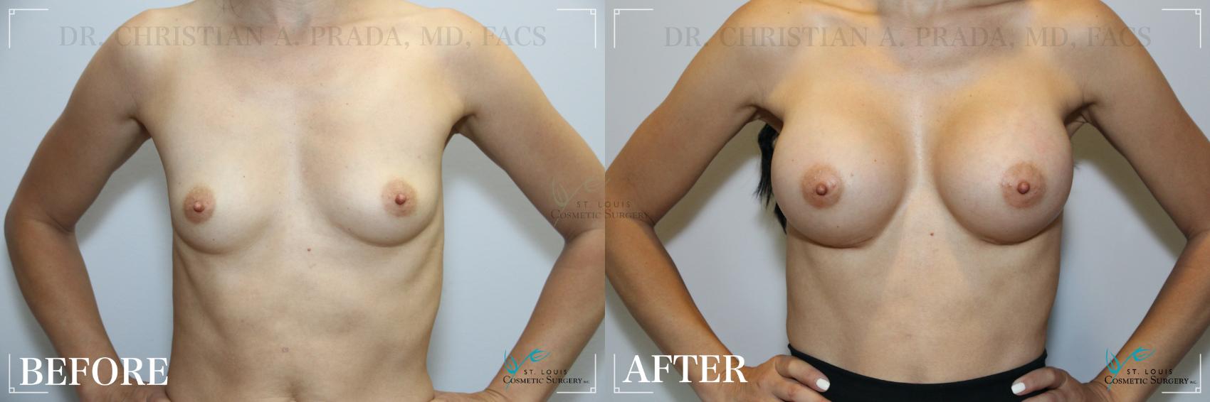 Before & After Breast Augmentation Case 230 Front View in St. Louis, MO