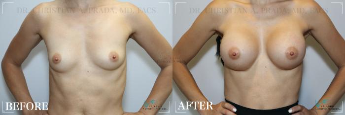Before & After Breast Augmentation Case 230 Front View in St. Louis, MO